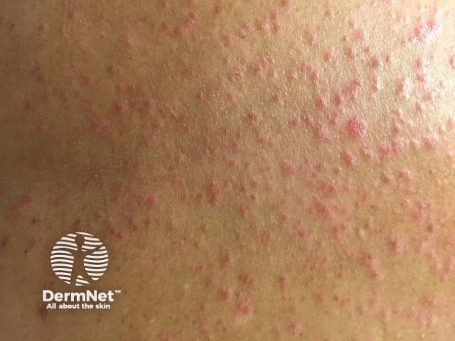 Guttate psoriasis