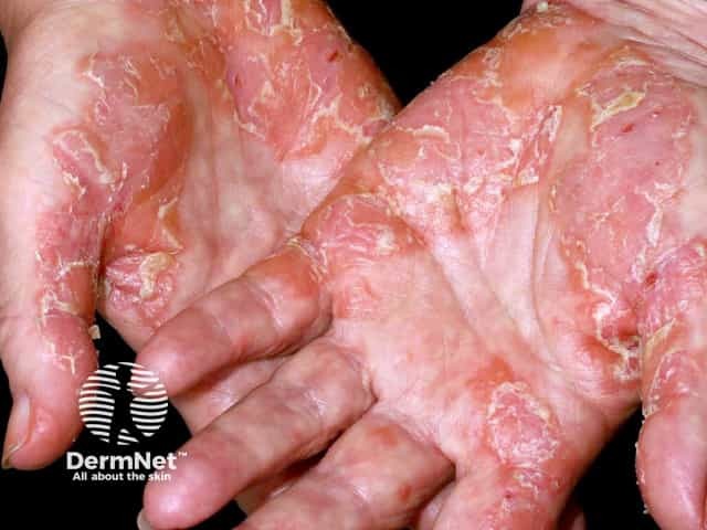 Palmar psoriasis