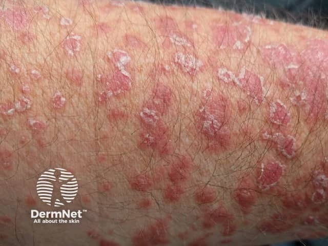 Psoriasis