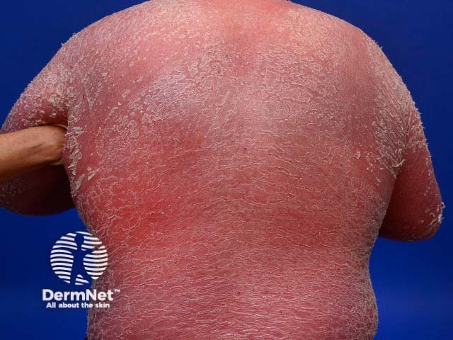 Psoriatic erythroderma