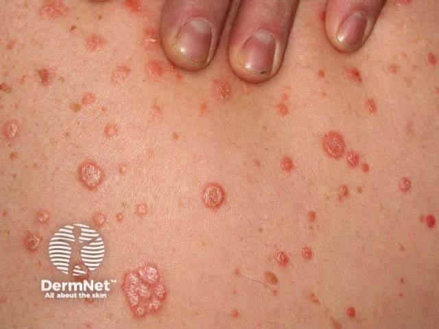 Guttate psoriasis