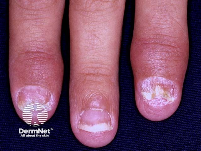 Nail psoriasis