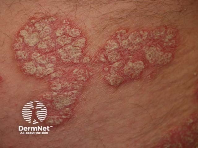 Plaque psoriasis