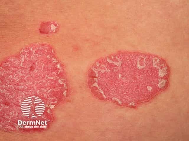 Chronic plaque psoriasis