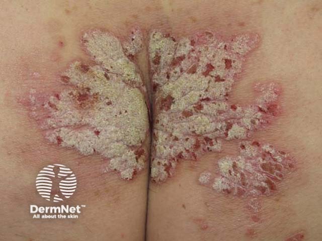 Severe psoriasis buttocks