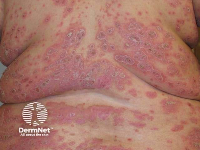 Severe psoriasis