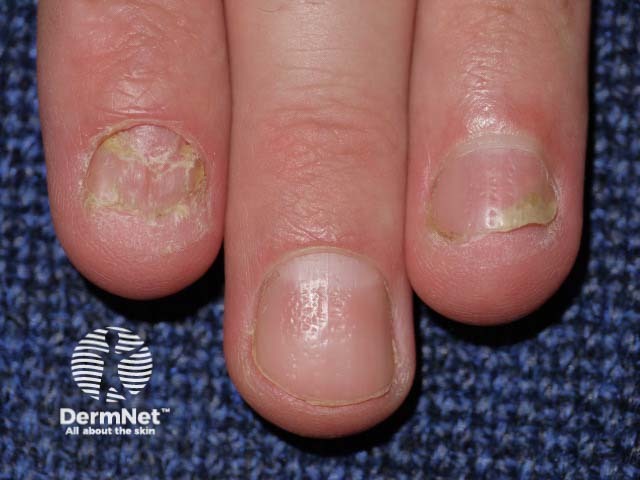 Psoriatic nail dystrophy