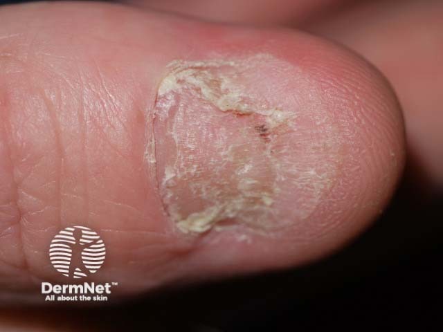 Psoriatic nail dystrophy