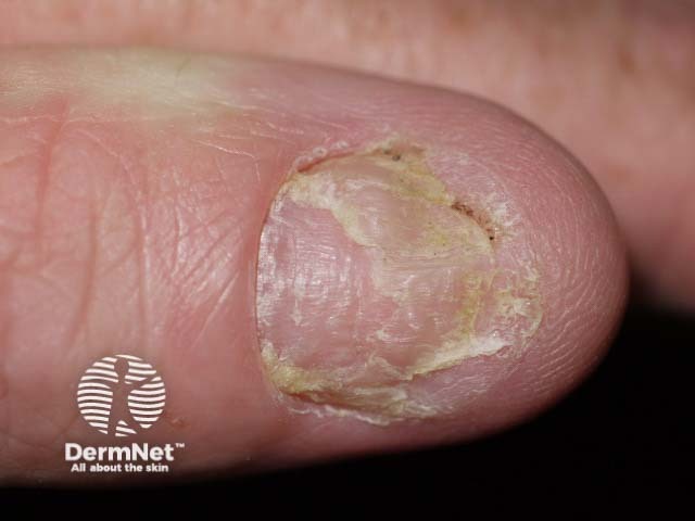 Psoriatic nail dystrophy