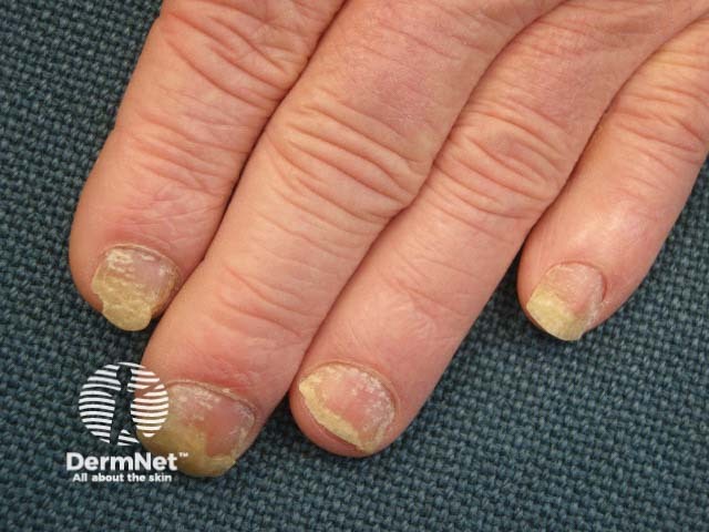 Psoriatic nail dystrophy