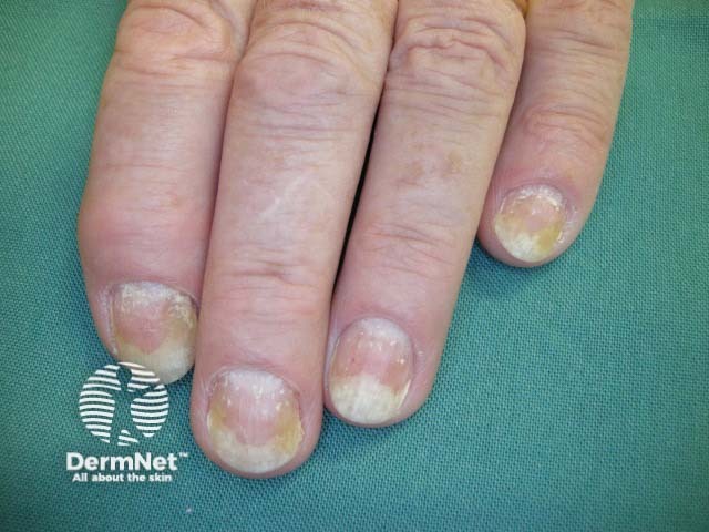 Psoriatic nail dystrophy