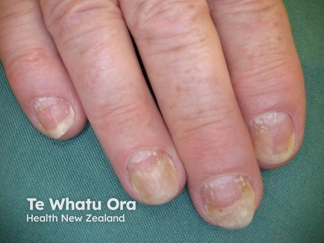 Psoriatic nail dystrophy