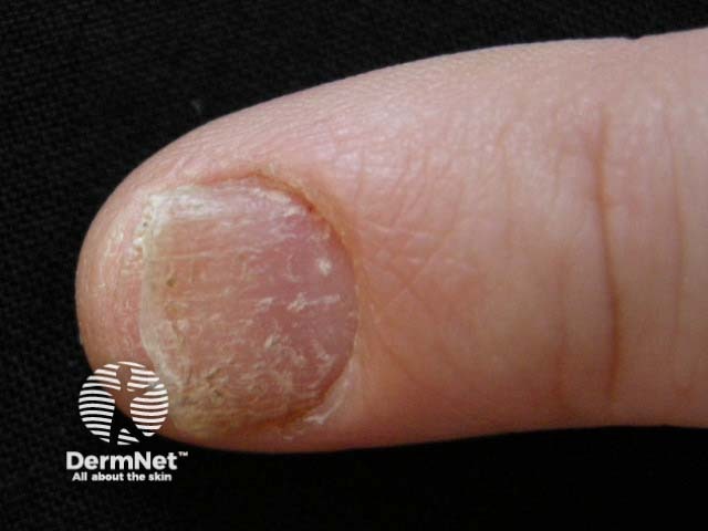 Psoriatic nail dystrophy