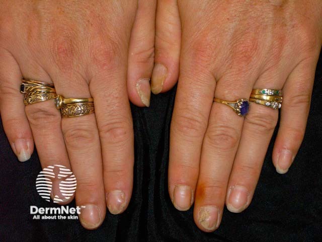 Psoriatic nail dystrophy