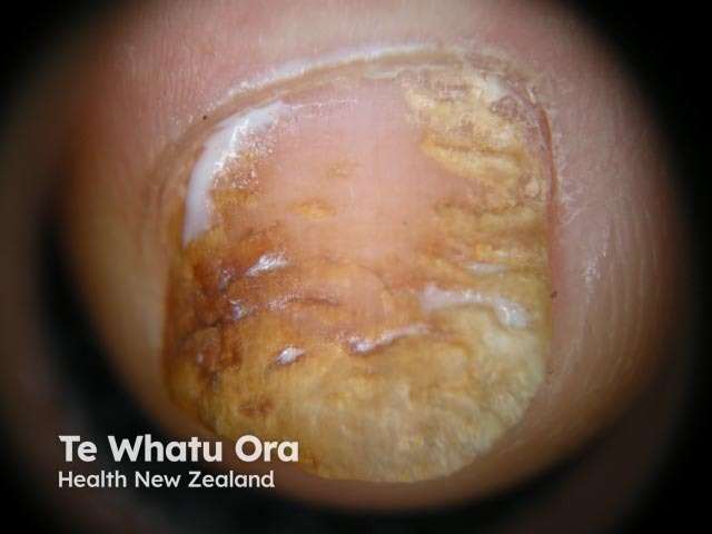 Psoriatic nail dystrophy