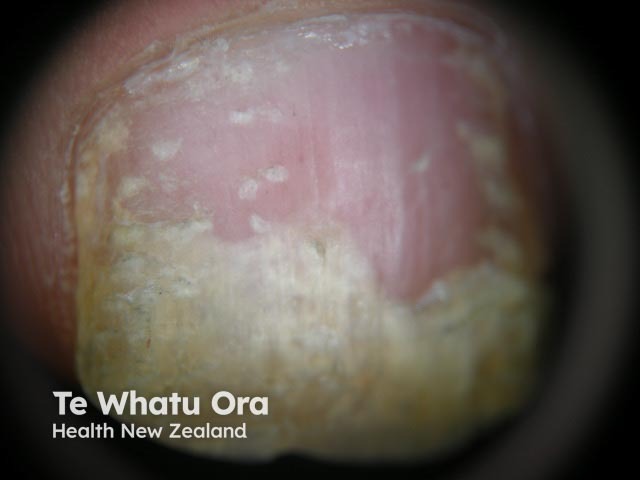 Psoriatic nail dystrophy