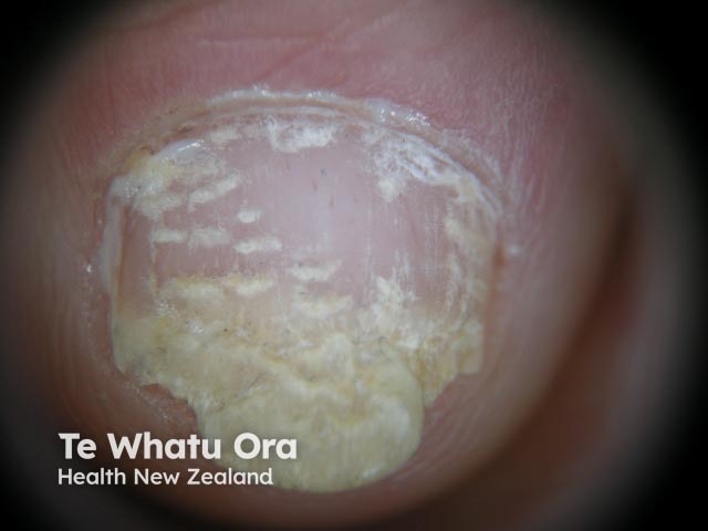 Psoriatic nail dystrophy