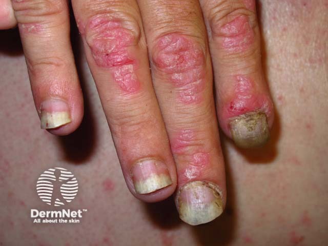 Psoriatic nail dystrophy