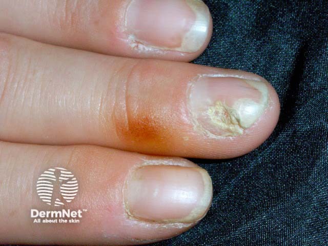 Psoriatic nail dystrophy