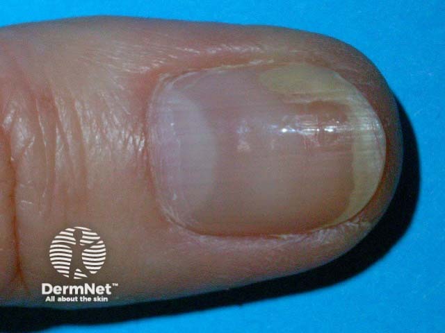 Psoriatic nail dystrophy