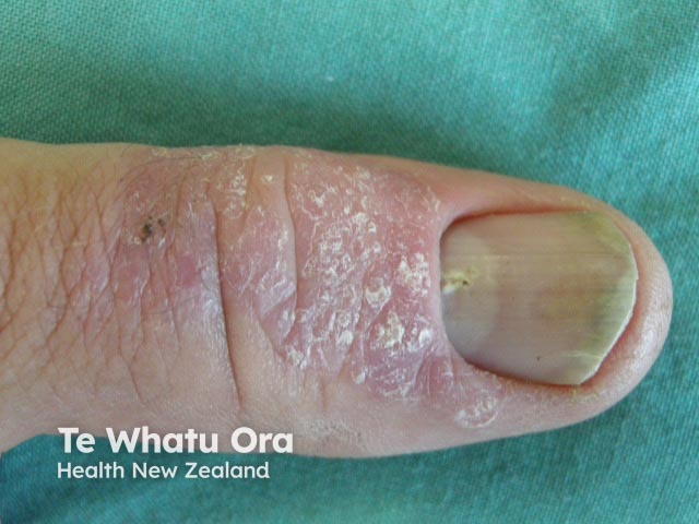 Psoriatic nail dystrophy