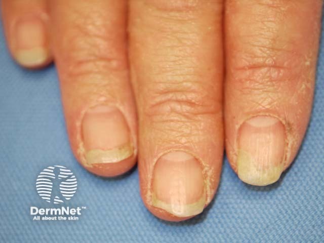 Psoriatic nail dystrophy