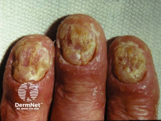 Psoriatic nail dystrophy