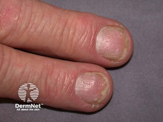 Psoriatic nail dystrophy