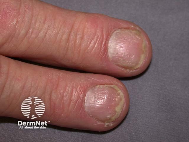 Psoriatic nail dystrophy