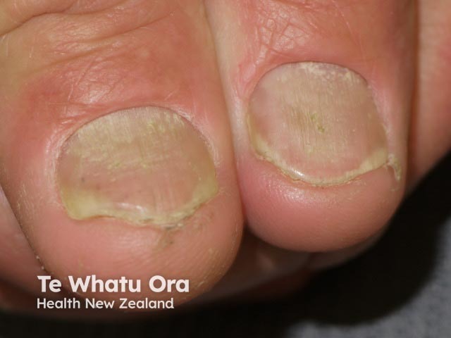 Psoriatic nail dystrophy