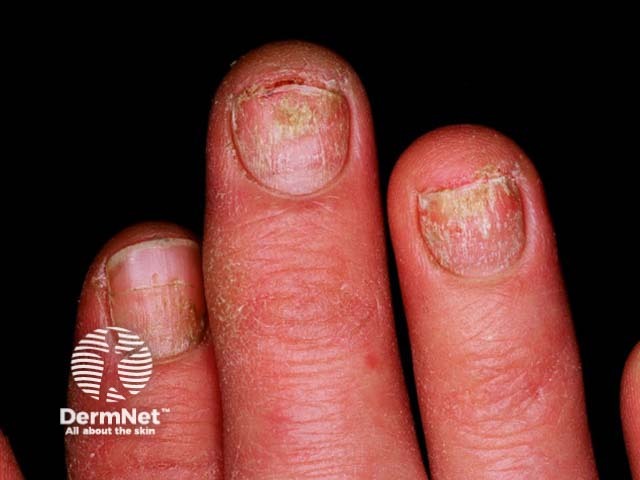 Psoriatic nail dystrophy