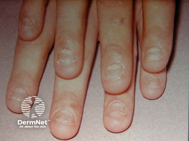 Psoriatic nail dystrophy