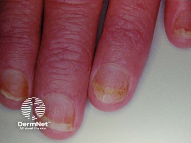 Psoriatic nail dystrophy