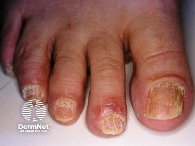 Psoriatic nail dystrophy