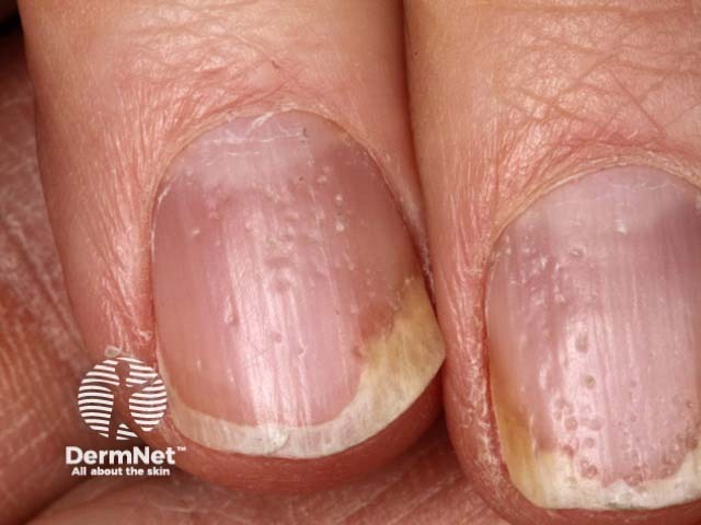 Psoriatic nail dystrophy