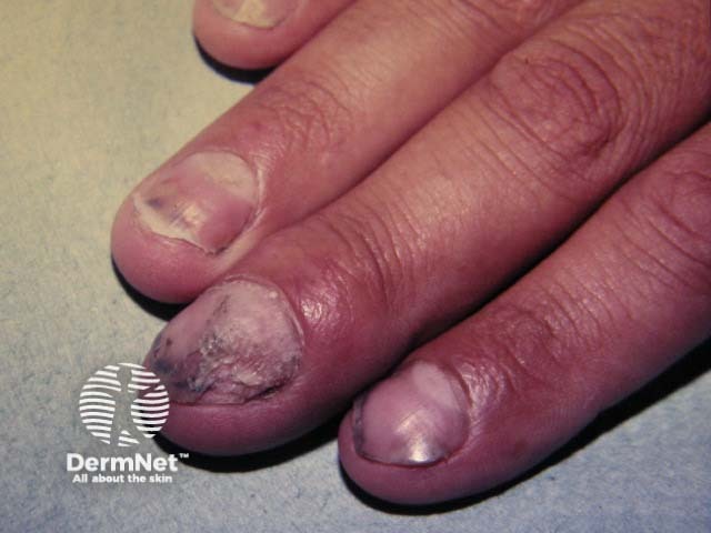 Psoriatic nail dystrophy