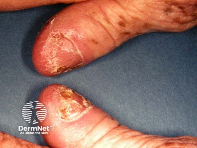 Psoriatic nail dystrophy