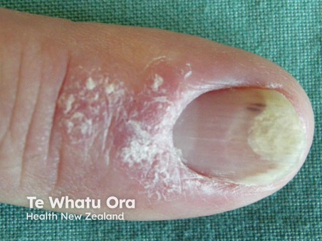 Psoriatic nail dystrophy