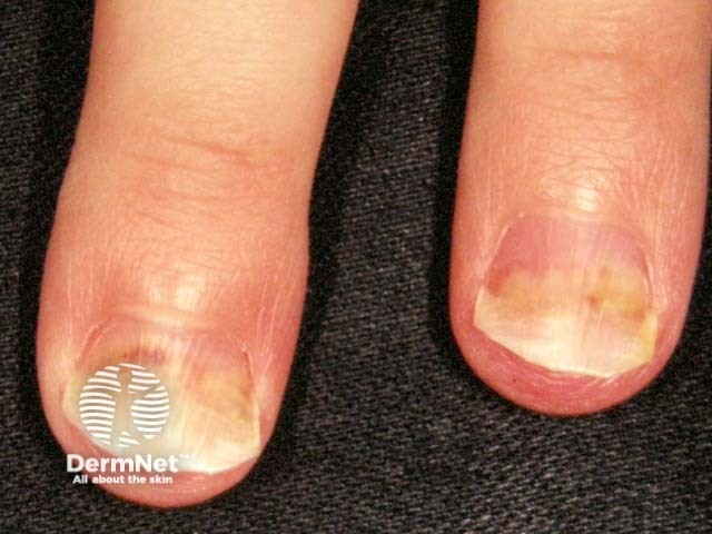 Psoriatic nail dystrophy