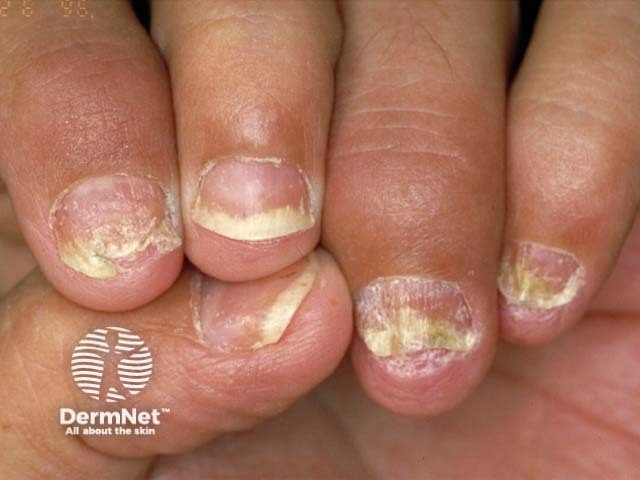 Psoriatic nail dystrophy