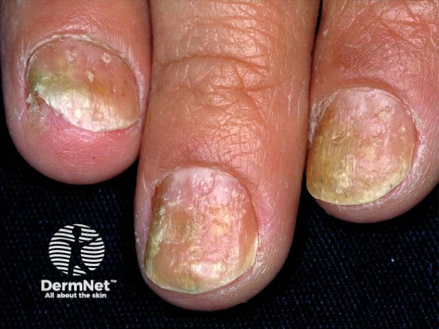 Psoriatic nail dystrophy