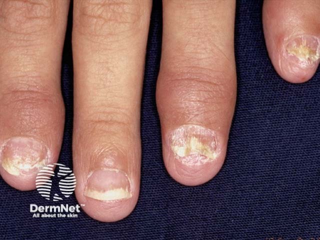 Psoriatic nail dystrophy