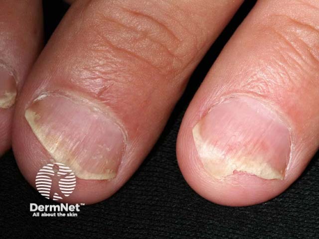 Psoriatic nail dystrophy