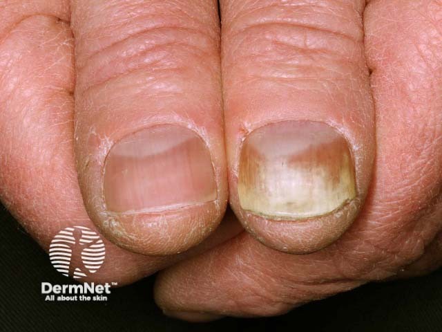 Psoriatic nail dystrophy