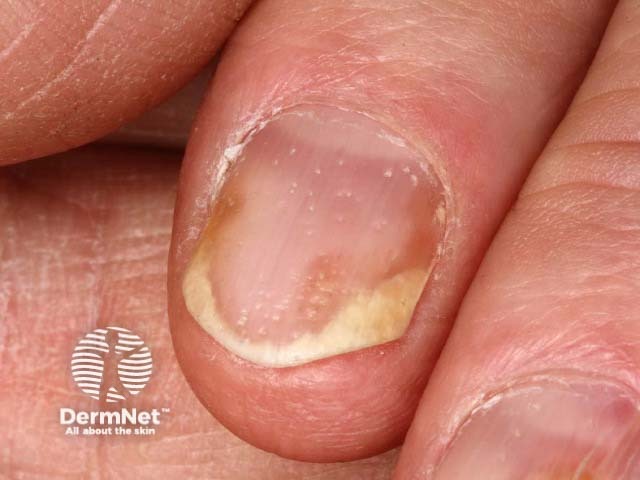 Psoriatic nail dystrophy