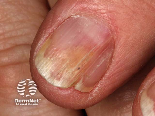 Psoriatic nail dystrophy