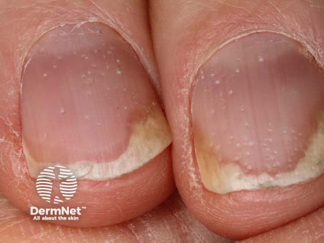 Psoriatic nail dystrophy