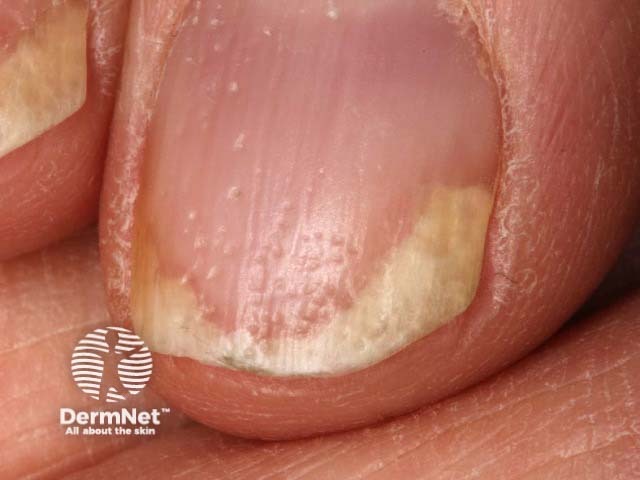 Psoriatic nail dystrophy