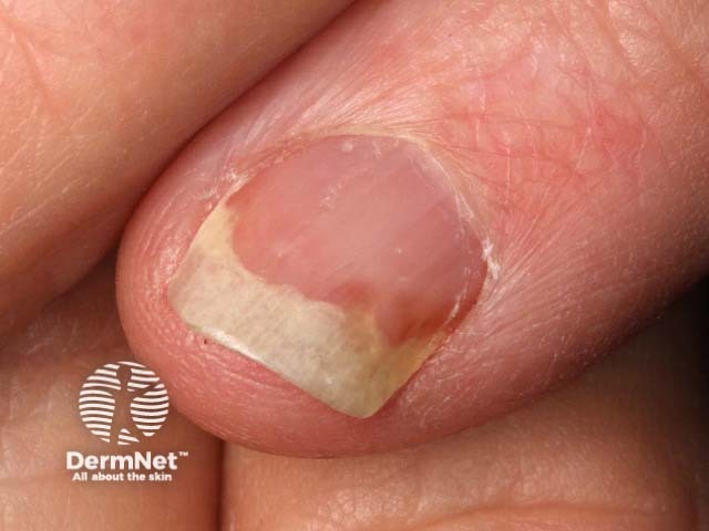 Psoriatic nail dystrophy