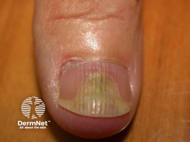 Psoriatic nail dystrophy